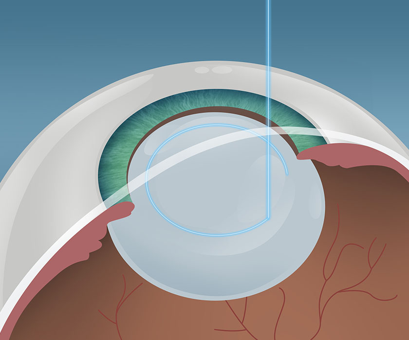 Schritt 1 Grauer Star Behandlung in Berlin-Wedding – Femto Phako – EyeCare Berlin