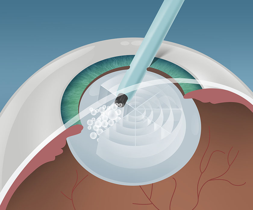 Schritt 2 Grauer Star Behandlung in Berlin-Wedding – Femto Phako – EyeCare Berlin