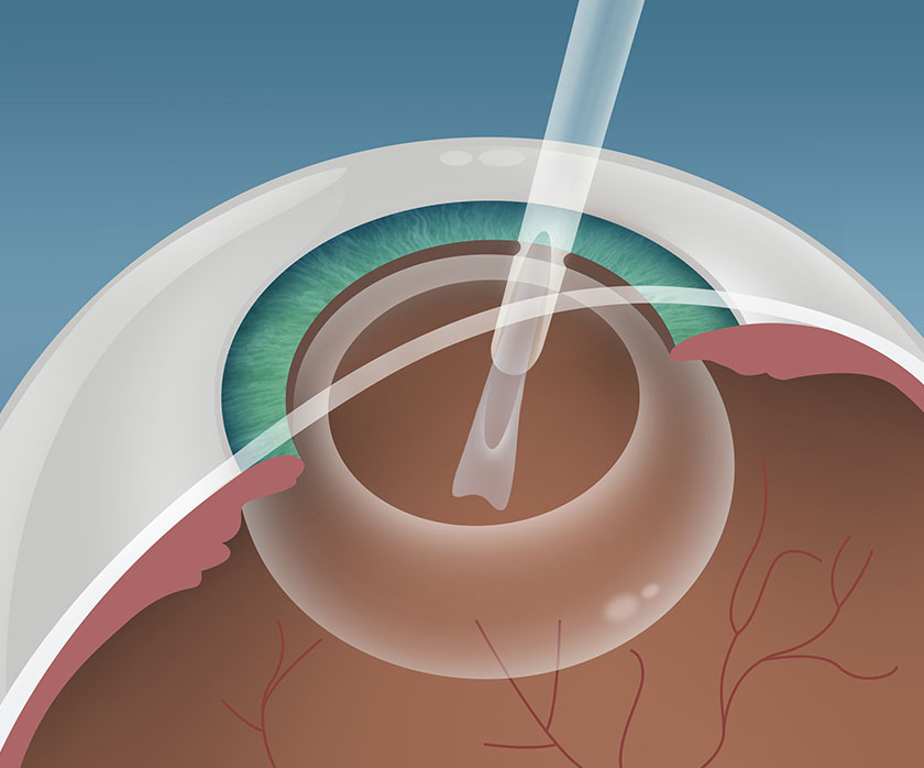 Schritt 3 Grauer Star Behandlung in Berlin-Wedding – Femto Phako – EyeCare Berlin