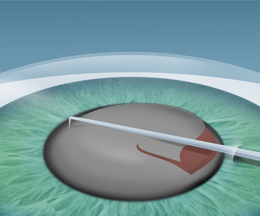 Schritt 1 Grauer Star Behandlung in Berlin-Wedding – Phakoemulsifikation – EyeCare Berlin