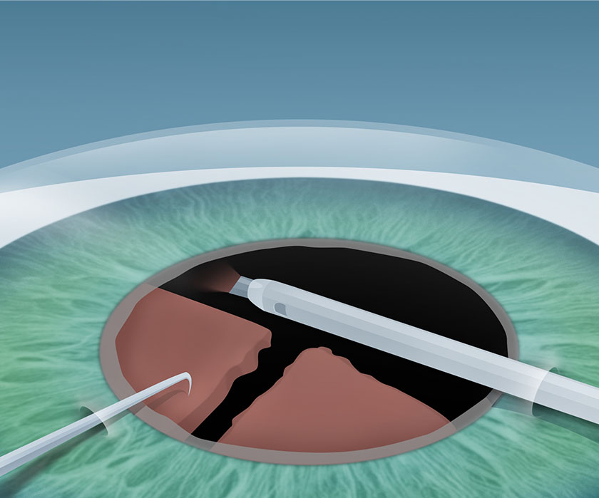 Schritt 2 Grauer Star Behandlung in Berlin-Wedding – Phakoemulsifikation – EyeCare Berlin