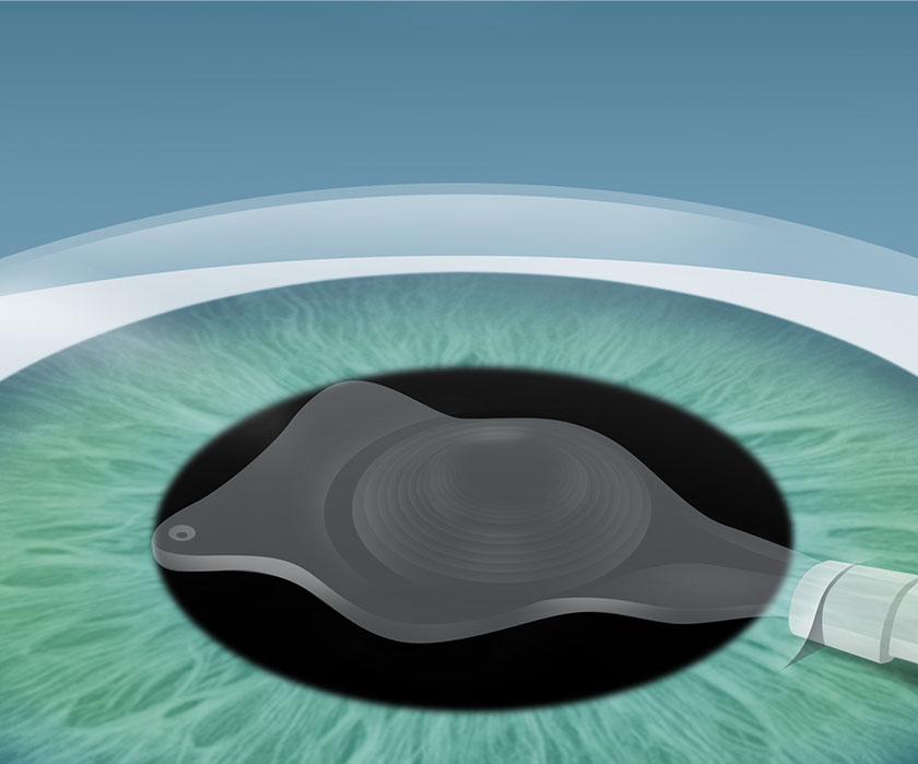 Schritt 3 Grauer Star Behandlung in Berlin-Wedding – Phakoemulsifikation – EyeCare Berlin